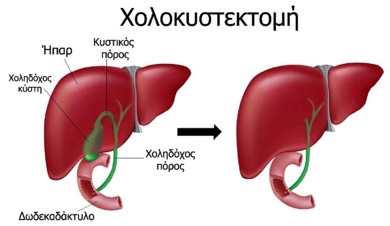 χολή