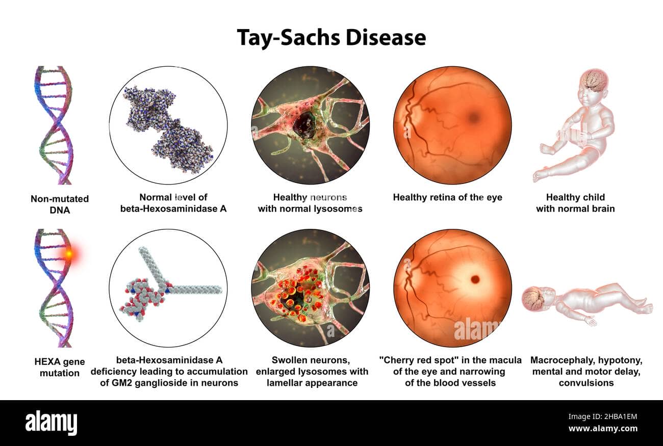 Tay-Sachs