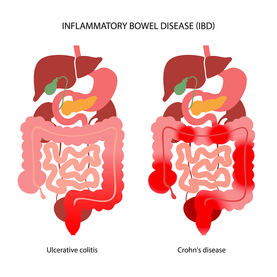 Νόσος Crohn ή ελκώδη κολίτιδα;