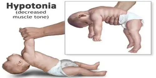 Νόσος Pompe