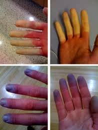 σύνδρομο Raynaud
