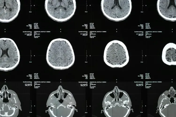 Πολλαπλή σκλήρυνση , ένα αυτοάνοσο νόσημα που μαστίζει Filippi, M., Rocca, M. A., Ciccarelli, O., De Stefano, N., Evangelou, N., Kappos, L., Rovira, A., Sastre-Garriga, J., Tintorè, M., Frederiksen, J. L., Gasperini, C., Palace, J., Reich, D. S., Banwell, B., Montalban, X., & Barkhof, F. (2016). MRI criteria for the diagnosis of multiple sclerosis: MAGNIMS consensus guidelines. The Lancet Neurology, 15(3), 292–303. https://doi.org/10.1016/s1474-4422(15)00393-2